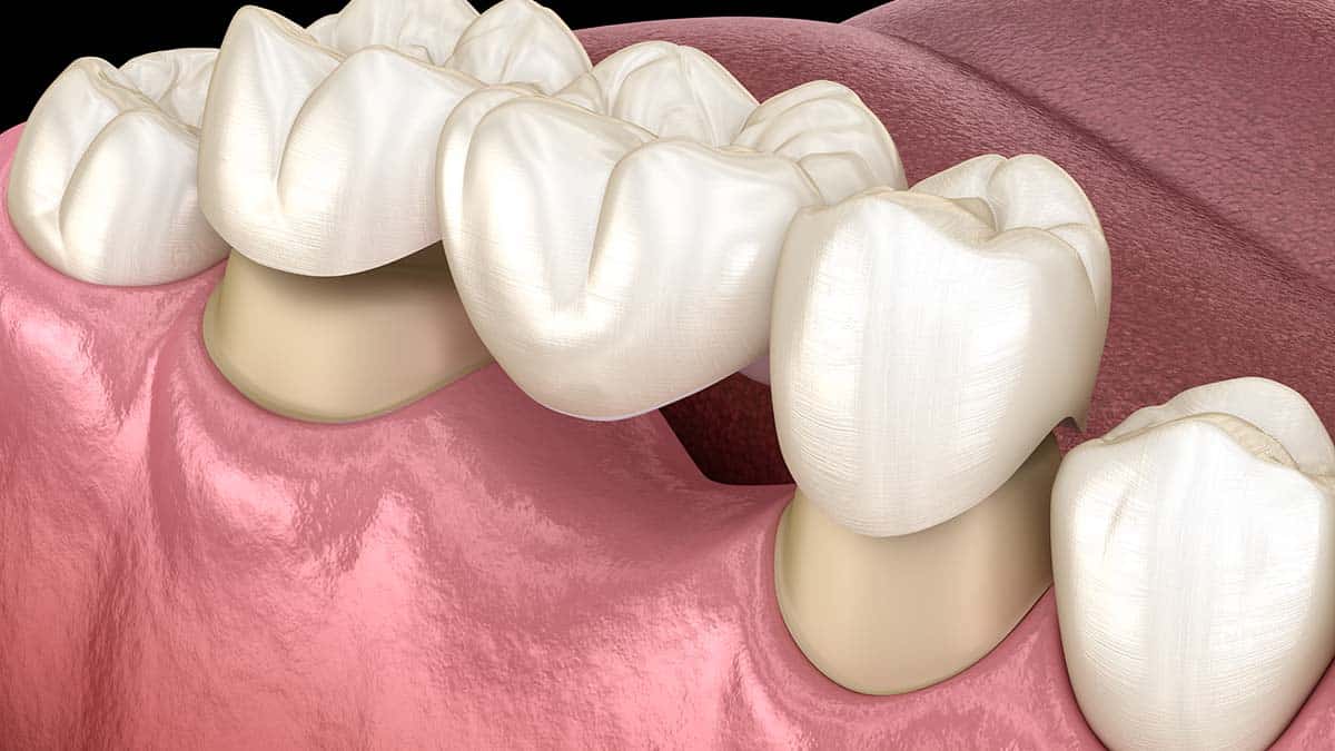 Understanding Dental Bridge Costs in Portland, OR