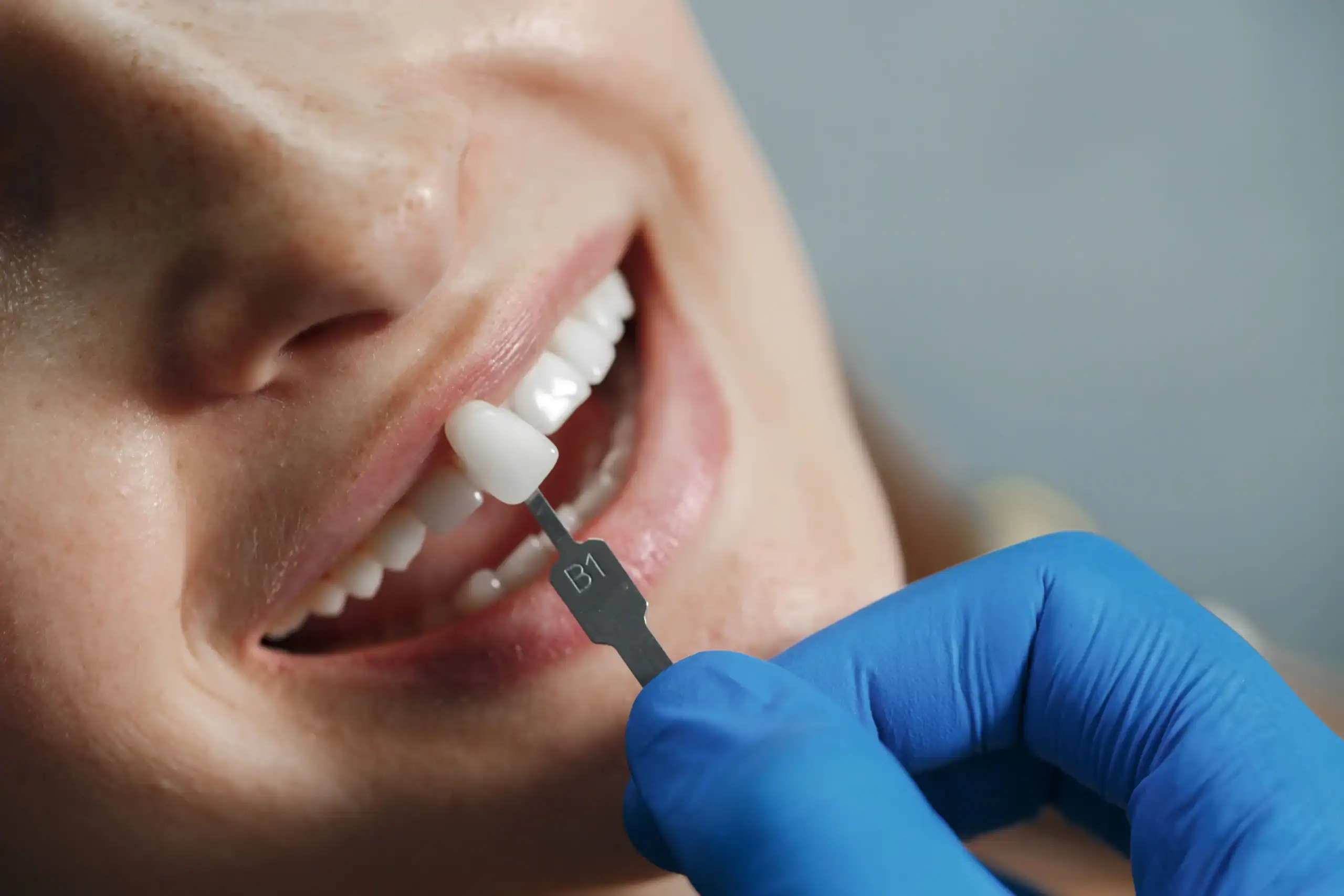 What to Expect: Getting Veneers in Portland, OR