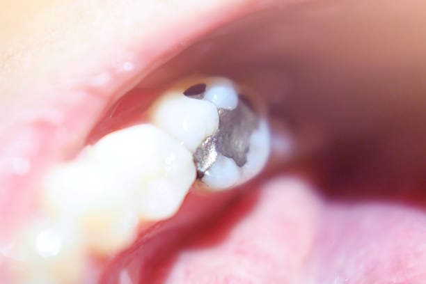 Signs Your Silver Fillings Need Replacement: Portland, OR Guide