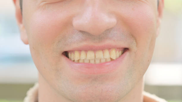 Common Causes of Tooth Discoloration Explained by Portland, OR Dentists
