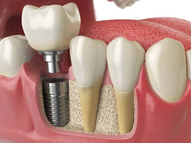 Are You a Candidate for Dental Implants in Portland? Expert Guide
