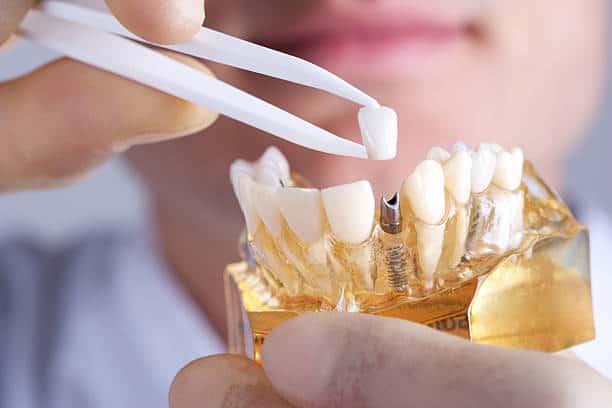Step-by-Step Dental Implant Procedure Guide for Portland Patients