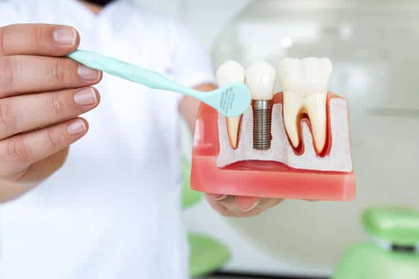 Dental Implant Recovery Timeline: What Portland Patients Should Expect