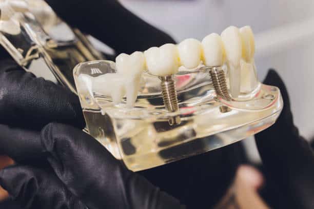 Understanding Dental Implant Costs in Portland: Complete Guide
