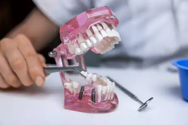 Dental Implants vs. Dentures in Portland: Which Is the Better Long-Term Value?