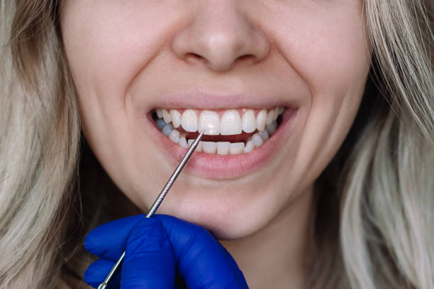 Fluoride Treatments in Portland: Do Adults and Kids Really Need Them?